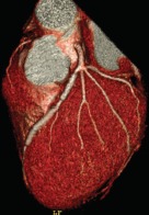 Cardiac CT Angiography*